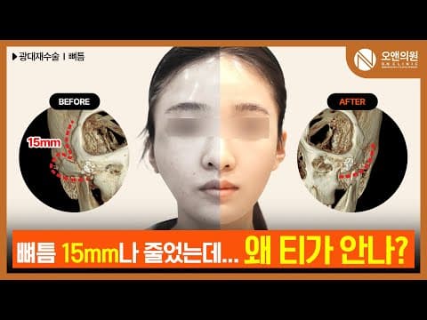 Cheekbone Revision (Bone Gap): Correcting Severe Asymmetry and Bone Gaps