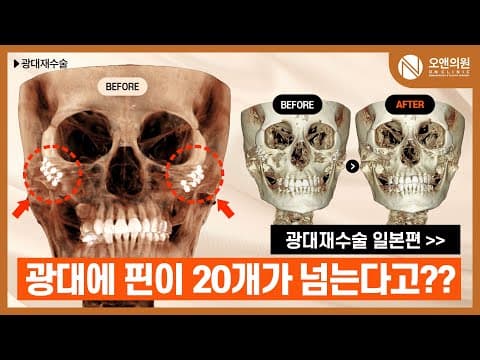 ON Facial Contouring Zygoma Revision: Repairing a Cheekbone With 20+ Pins