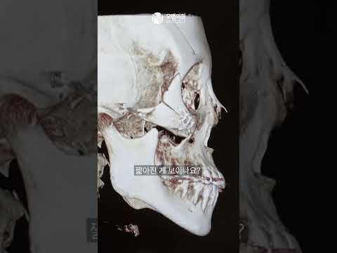 Zygoma Revision: Correcting Nonunion and Asymmetry, Shortening the Midface