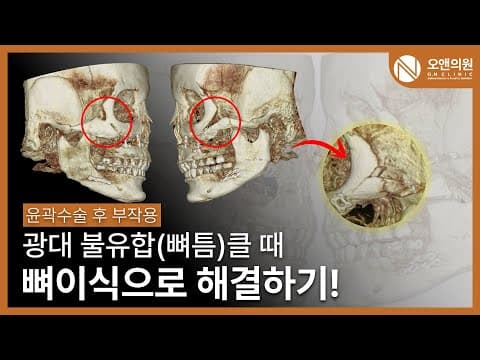 骨の隙間(不癒合)への骨移植:副作用が大きい時の頬骨再建