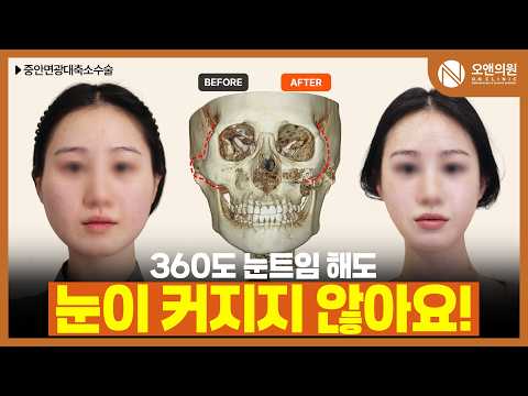 Midface Cheekbone Reduction for a Long, Wide Face: Eyes Look Bigger Too