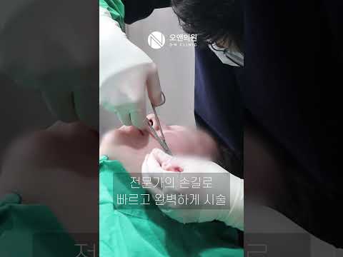 ON Clinic Thread Lifting: Improving Nasolabial Folds and Facial Sagging