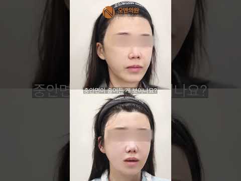 中顔面縮小再手術、骨に穴が開いた顔を10mm以上縮小した記録