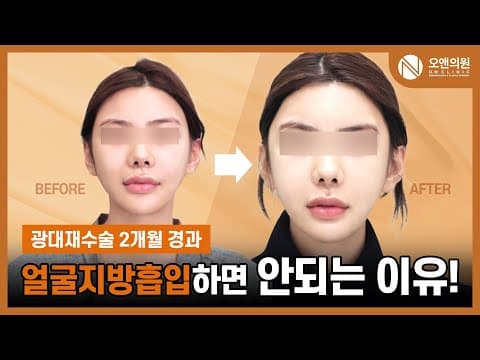 頬骨再手術(非対称・骨不癒合)後のこめかみ突出と頬のたるみを改善