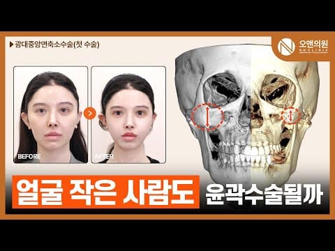 オーアン頬骨・中顔面縮小手術:顔が小さくても輪郭は可能?