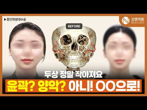 頬骨再手術でミスコリア顔に変身:頭の形まで小さくなった結果