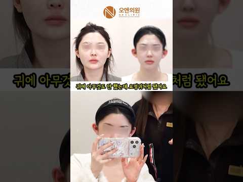 Facial Change Starting from the Bone: A Square Face Turned Fairy-Like
