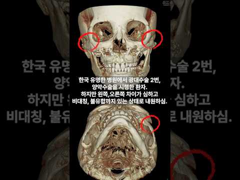 Zygoma and Jaw Reconstruction with Severe Asymmetry and Non-Union