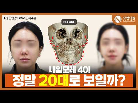 Anti-aging contouring: midface zygoma & V-line review, mistaken for her 20s