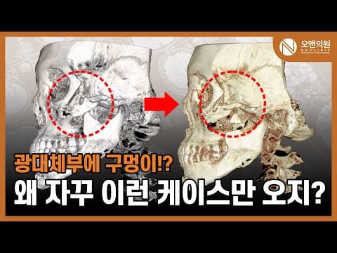頬骨再手術:頬骨体部の穴に骨移植、なぜこんなケースばかり来るのか?