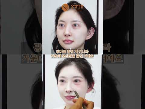 Zygoma Reduction and Midface Reduction 1 Year Progress: How Far Do the Results Hold Up?