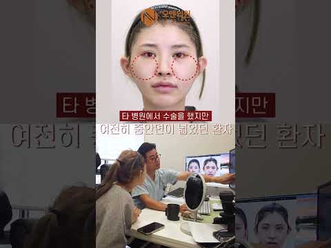 재수술로 중안면 축소 및 계란형 얼굴 완성: 눈도 커지는 효과