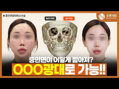 ON Facial Contouring Midface and Zygoma Reduction: Shrinking the Midface