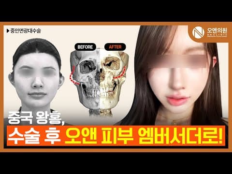 ON Midface Cheekbone Reduction: Chinese Influencer Ambassador Review