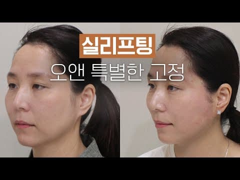 O.N Thread Lift: A Special Fixation Method for Sagging Face Improvement
