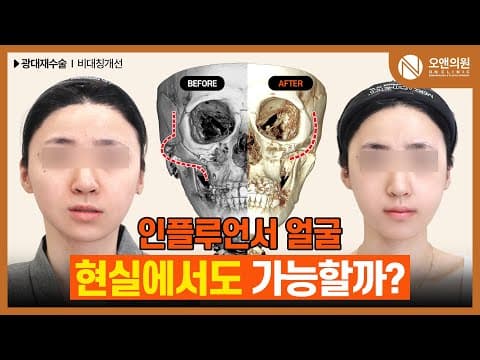 광대재수술: 원하는 얼굴형으로 만드는 맞춤 광대 재수술