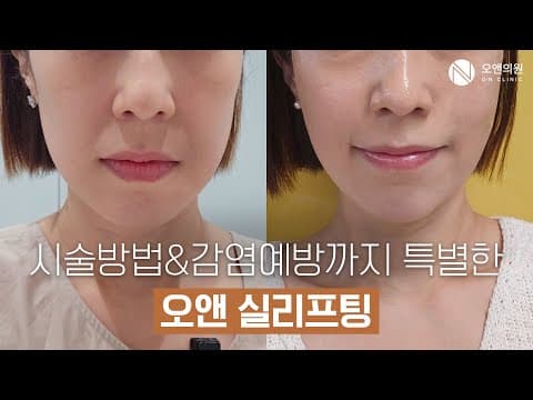 ON Clinic Thread Lift: PDO Treatment for Sagging Cheeks With a Before and After Look