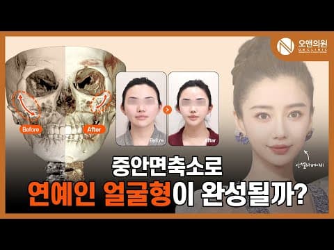 Zygoma Midface Reduction Surgery: Can Midface Reduction Create a Celebrity Face Shape?
