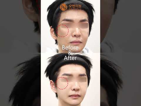 Cheekbone Indentation: A Stair-Step Effect, Not Non-Union, Fixed by Bone Grafting