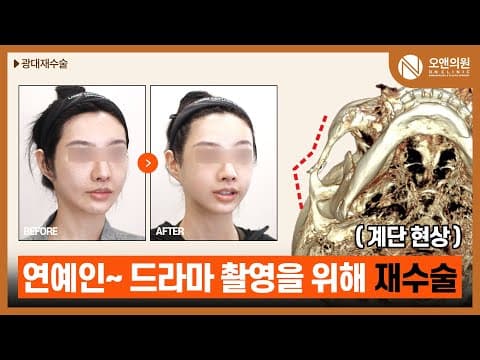 頬骨再手術後の階段現象、芸能撮影のための3D頬骨縮小術レビュー