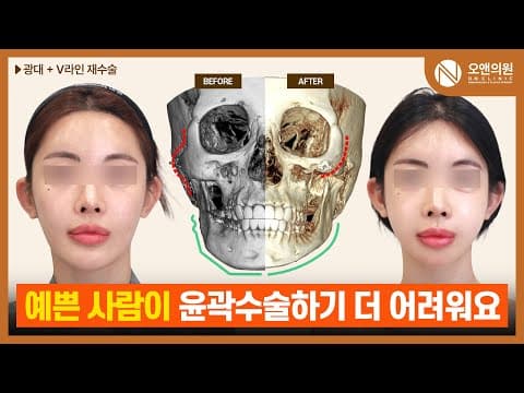 On Clinic面部轮廓颧骨V脸再手术:越漂亮越难