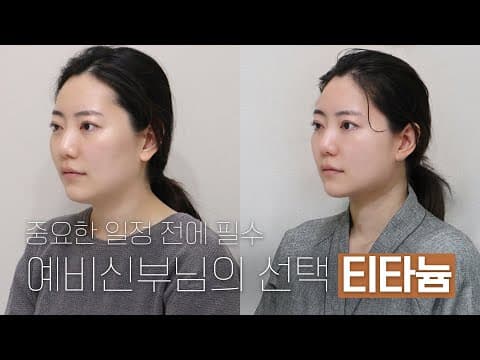 Titanium Lifting Chosen by a Bride-to-Be: A Must Before the Big Day