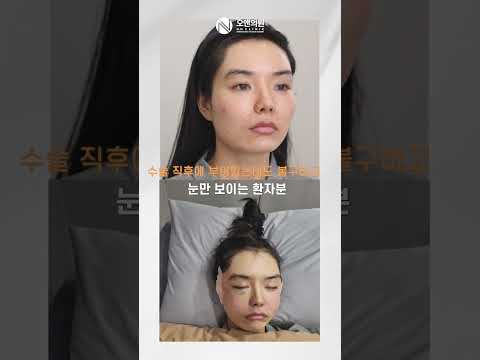 The Secret to Bigger Eyes? Better Facial Proportions via Midface Reduction