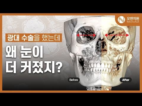 Zygoma and Midface Reduction Asymmetry Correction: Bigger Eyes Too