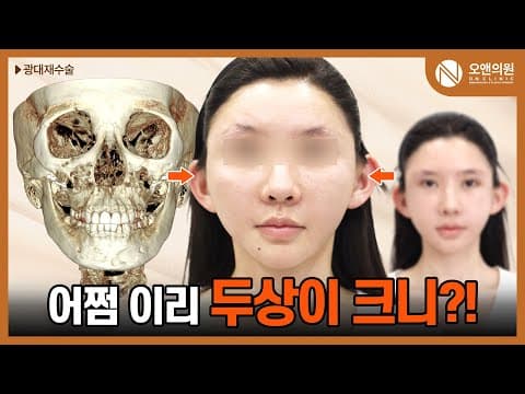 ON Clinic Zygoma Revision: A Case of an Unusually Large Head