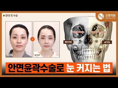ON Malar Midface Reduction: First Zygoma Surgery to Make Eyes Look Bigger