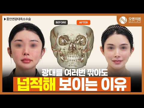 Ultherapy and Thermage Combined into One Single Session With Oligio KISS