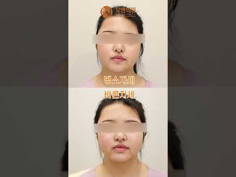 Zygoma Asymmetry Surgery Recovery and Care: Cheekbone Body Bone Graft Case