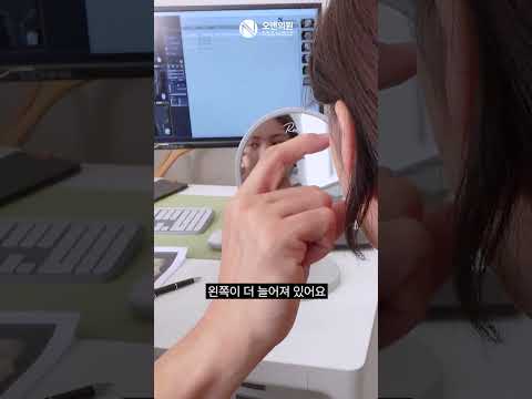 Zygoma Reduction Surgery for Facial Asymmetry: A Real Case the Patient Loved