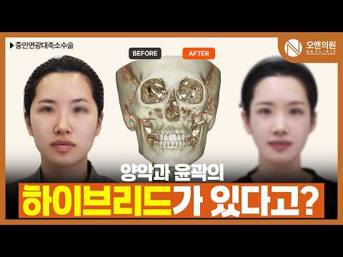 Midface zygoma reduction for facial proportion: jaw-contour hybrid surgery