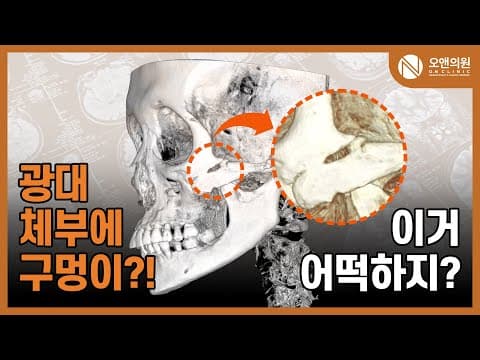 頬骨再手術(頬骨体部の骨欠損へ骨移植):穴の開いた頬骨どうする?