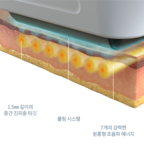 1.5mm Mid-Dermis Targeting